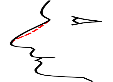 La rhinoplastie réparatrice du nez