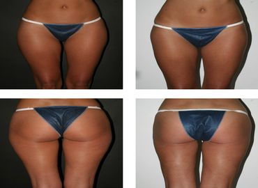 Tout savoir sur la liposuccion