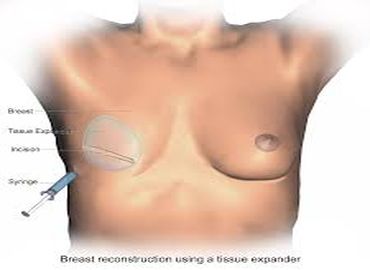 Tout savoir sur la reconstruction mammaire par lambeau