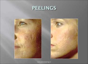 Le teint éclatant : plutôt peeling ou laser ?