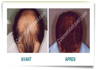 Tout savoir sur la greffe de cheveux FUE