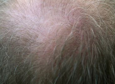 La dermofusion : la solution idéale contre la chute des cheveux