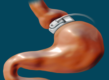L\'Anneau gastrique tunisie : en quoi cela consiste-t-il ?