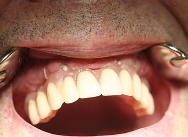 Les effets des prothèses dentaires sur la qualité de vie de l'homme