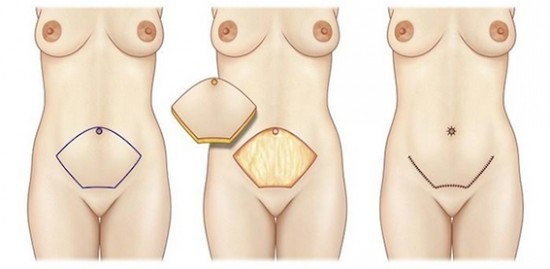 abdominoplastie tunisie