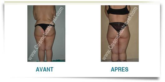 Photos abdominoplastie avant apres femme