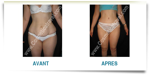 abdominoplastie femme