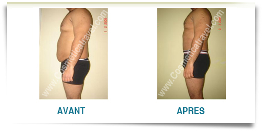 abdominoplastie homme avant apres