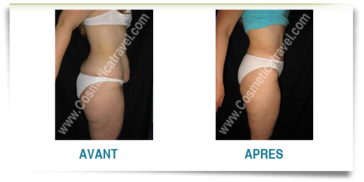 abdominoplastie avant apres