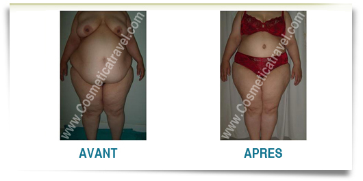 photos abdominoplastie