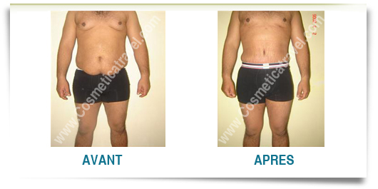 cicatrices abdominoplastie avant après