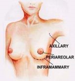 Augmentation des seins par pose de prothèses ou implants mammaires 3