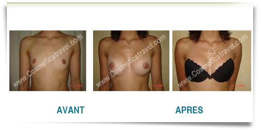 Photos augmentation mammaire avant apres