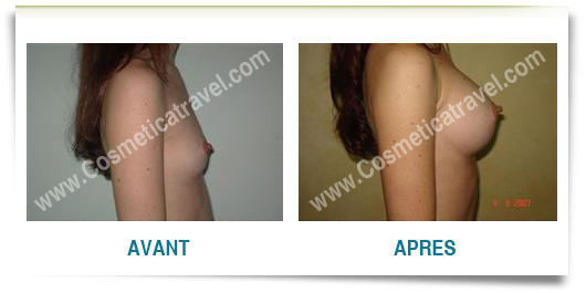 Photos implant mammaire avant apres