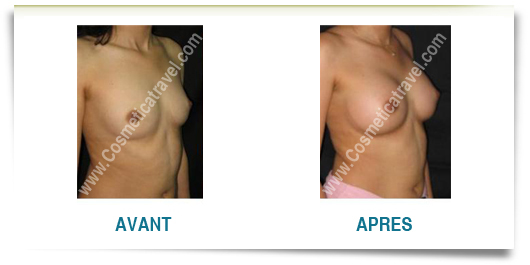 augmentation mammaire photos avant apres femme