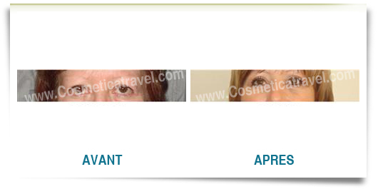 Photos blepharoplastie avant apres femme