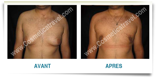 Gynecomastie avant apres