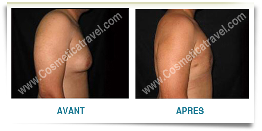 Photos gynecomastie avant apres