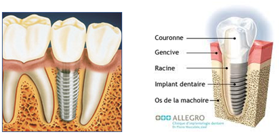 Qu'est-ce qu'un implant dentaire ?