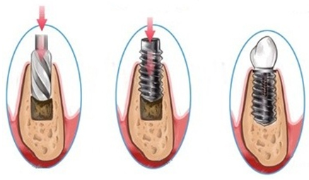 Mise en place de l'implant dentaire