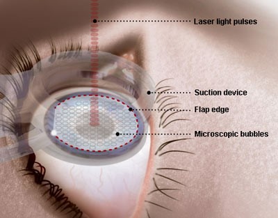 LASER FEMTOSECOND