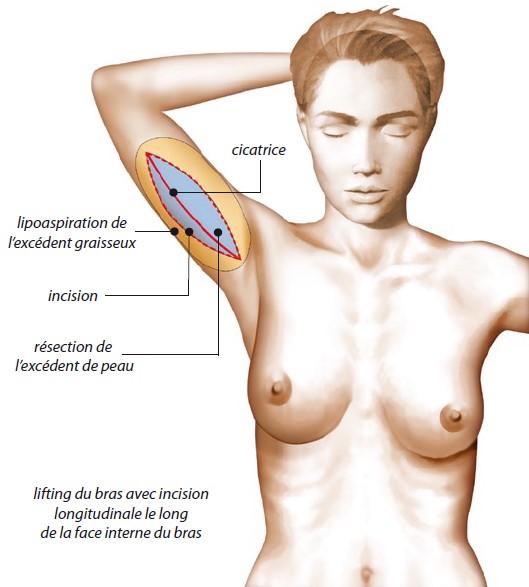 Lifting de bras avec incision longitudinale le long de la face interne du bras