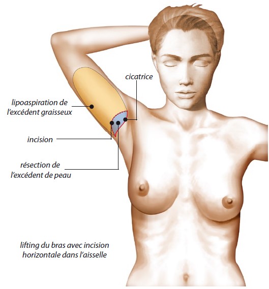 Lifting de bras avec incision horizontale dans l’aisselle