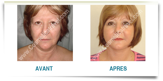 Lifting cervico facial photos avant apres