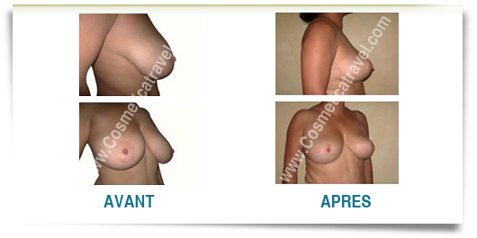 Reduction mammaire photos