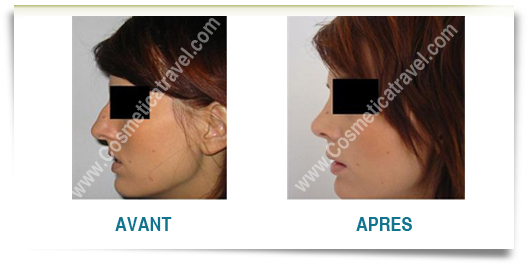 Photos rhinoplastie avant apres