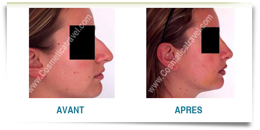 Rhinoplastie femme